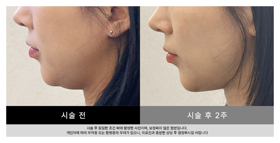 전후사진