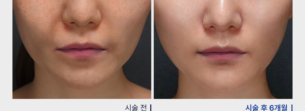 전후사진